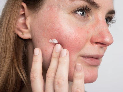 April ist der Rosacea Awareness Month