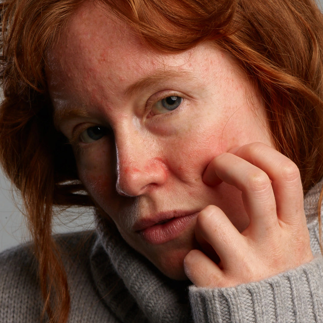 Von Rosacea betroffene Frau, mit Rötungen und Pusteln auf dem Gesicht