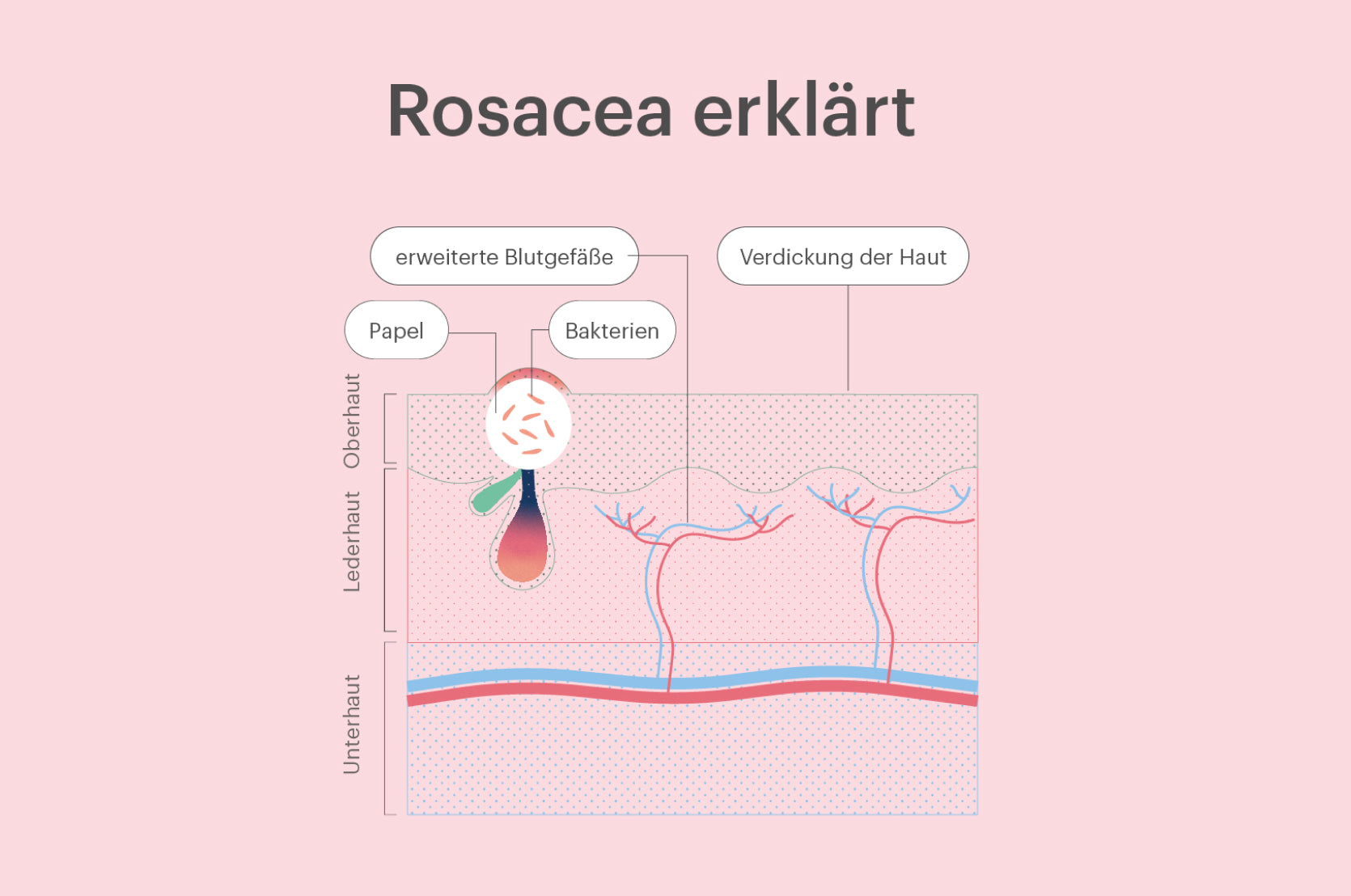 Rosacea: Was gegen die Hautkrankheit wirklich hilft