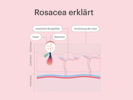 Rosacea: Was gegen die Hautkrankheit wirklich hilft