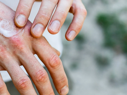 Trockene Hände im Winter? Das kannst du dagegen tun
