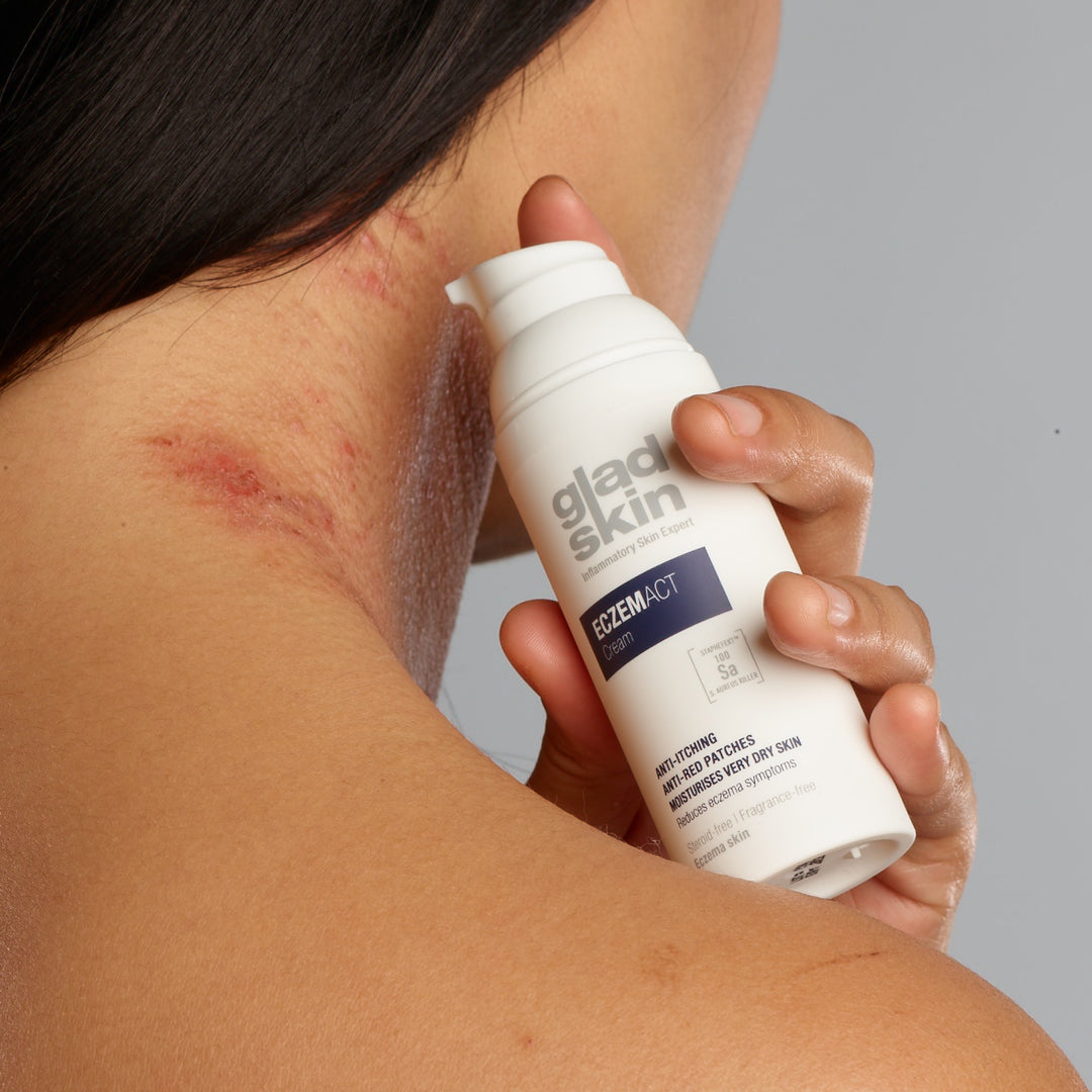 Frau mit Neurodermitis verwendet Eczemact Cream auf dem Hals