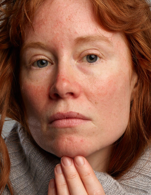 Rosacear Pflegeset - Auf die speziellen Bedürfnisse der Reinigung und Behandlung der Symptome von zu Rosacea neigender Haut eingeht