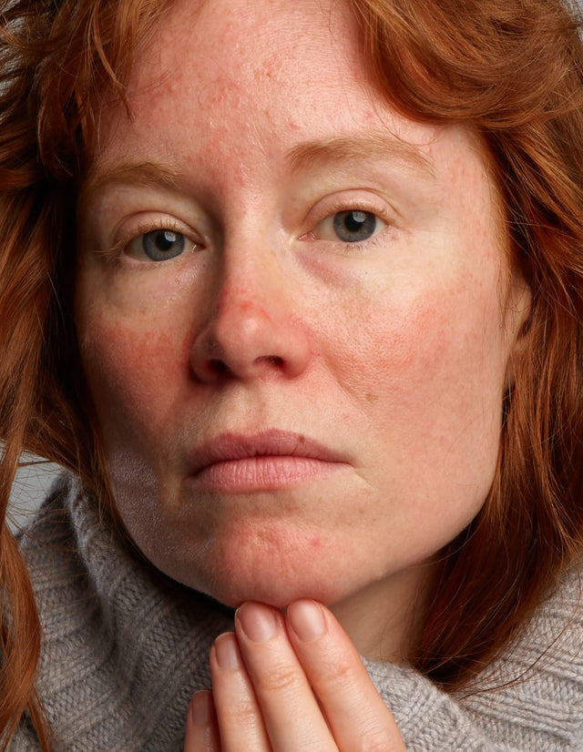 Rosacear Pflegeset - Auf die speziellen Bedürfnisse der Reinigung und Behandlung der Symptome von zu Rosacea neigender Haut eingeht