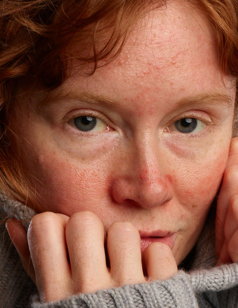 ROSACEAR Gel und Cream, für Tag und Nacht geeignet, Rosacea-Symptome effektiv behandeln