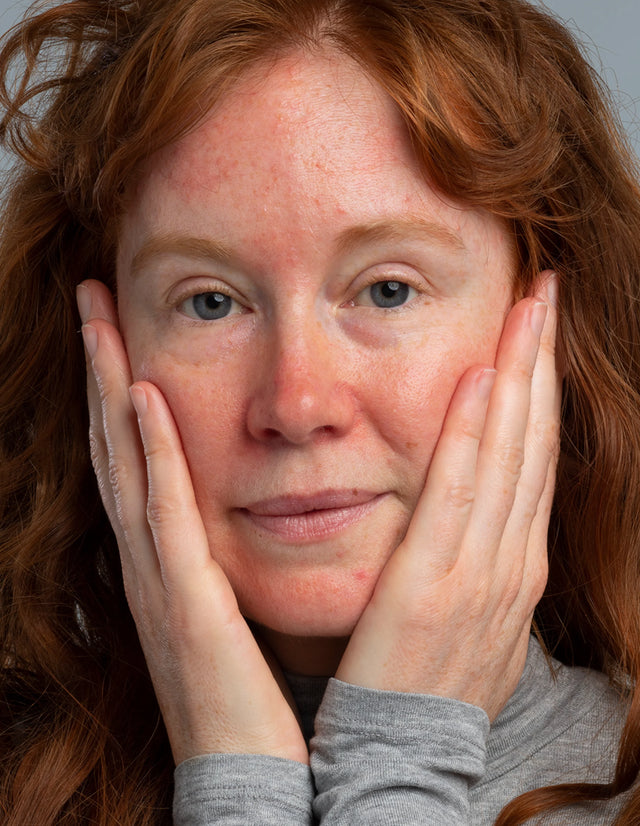 Rosacea Care Set Plus - Gegen Rötungen und Pusteln, gegen brennendes Gefühl, beruhigt die Haut und spendet ihr Feuchtigkeit