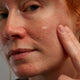 Von Rosacea betroffene Frau, die Rosacear Gel auf dem Gesicht benutzt