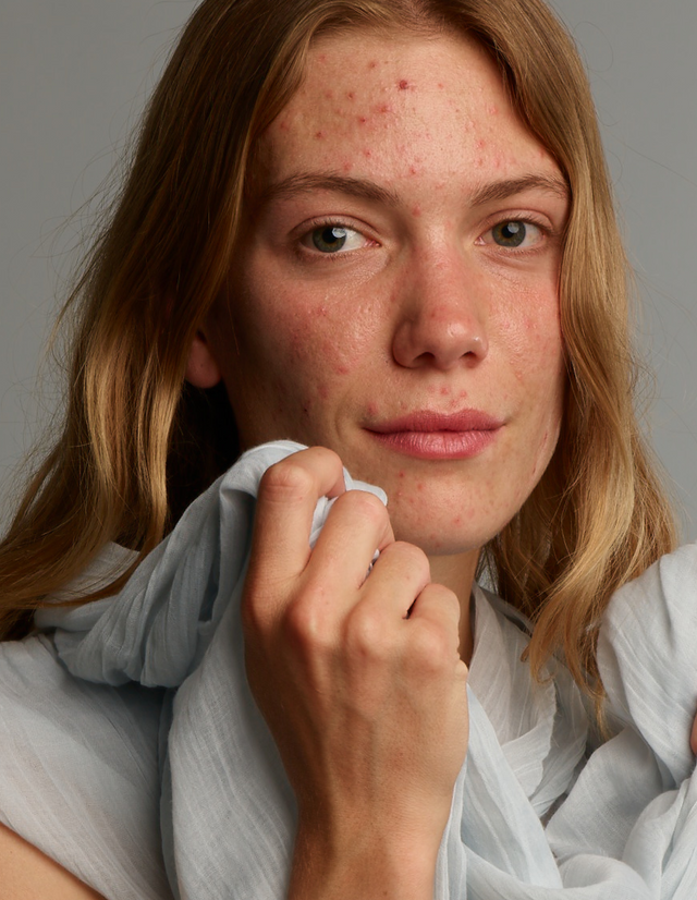 ACNEFEKT Care Set Plus - Routine zum entfernen von Make-up, reinigen, behandeln und zur Feuchtigkeitspflege von zu Akne neigender Haut