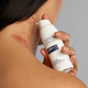 von Neurodermitis betroffene Frau nutzt Eczemact Cream